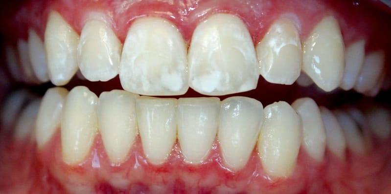 Taches Blanches Alarmantes Sur Les Dents Causes Et Comment Les Corriger