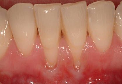 Receding gum lines can be a warning of other oral issues Receding gum lines can be a warning of other oral issues