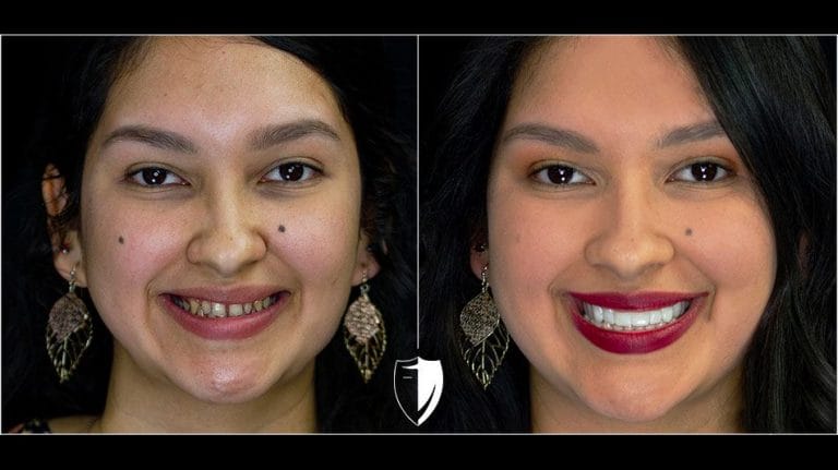 bilveneers-client-cristina