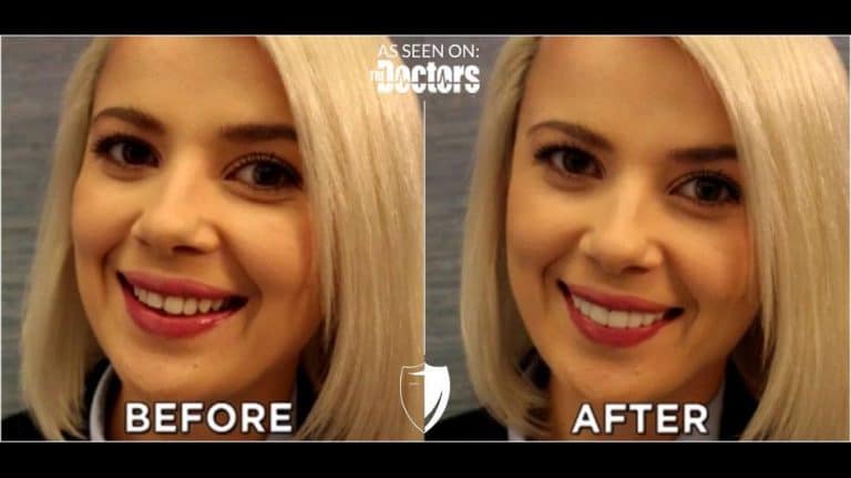 BilVeneers client Mika