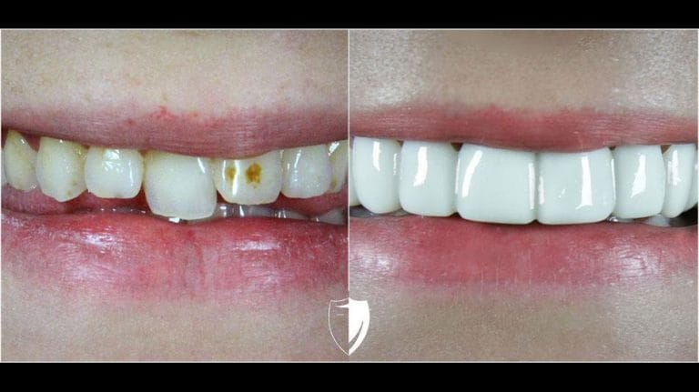 bilveneers-client-tamra-p-ba