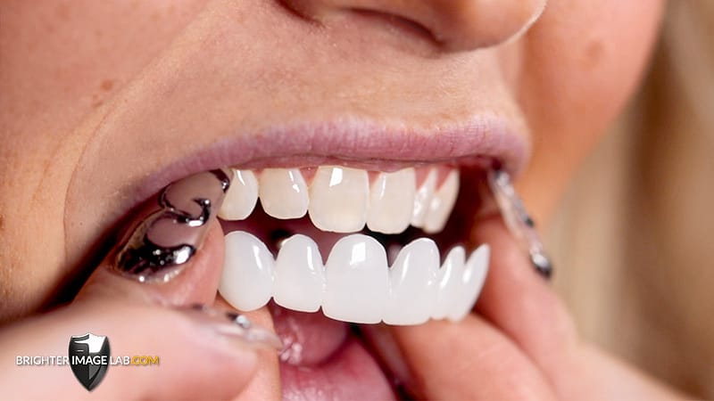 Jordan S veneers teeth