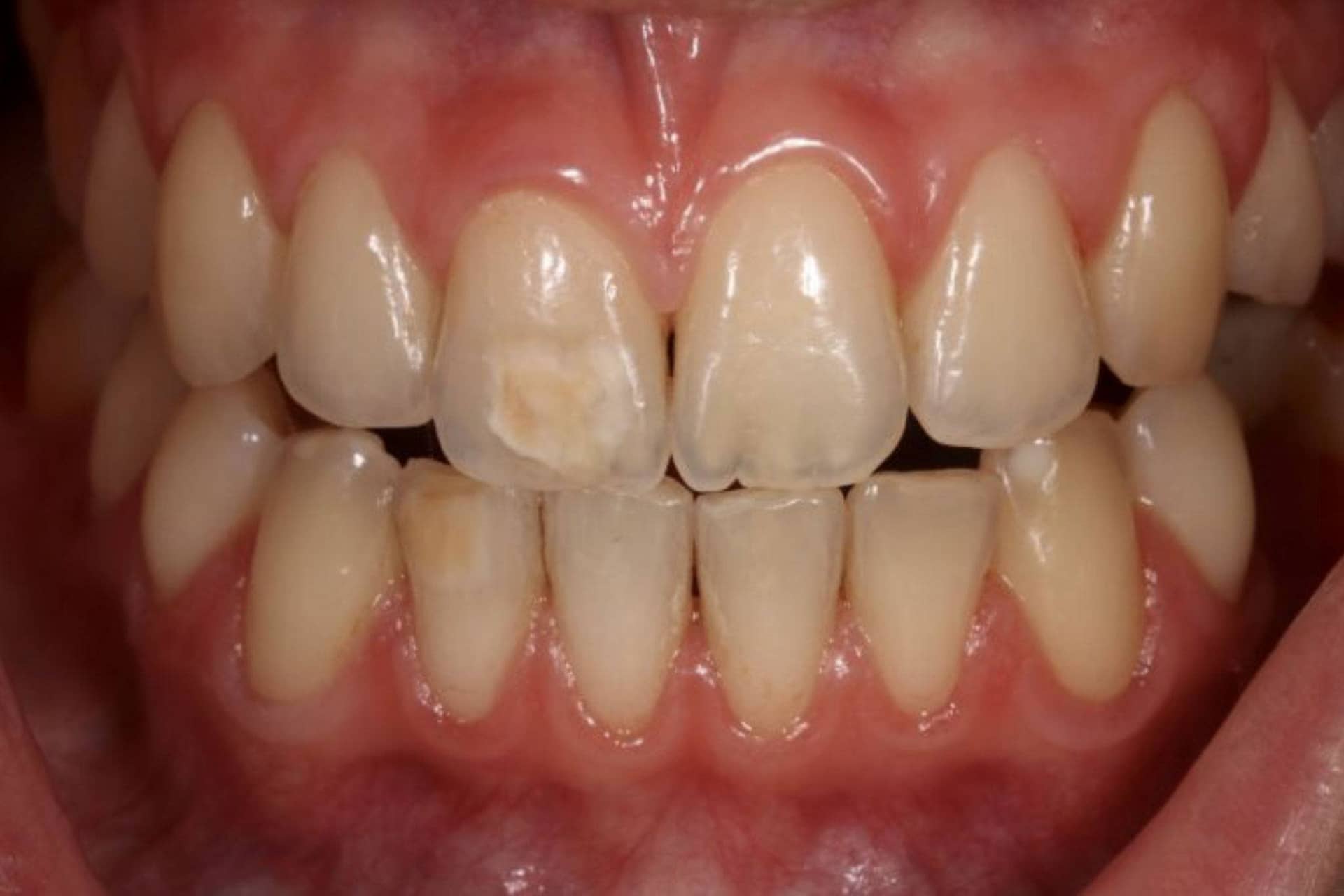 brown spots on teeth