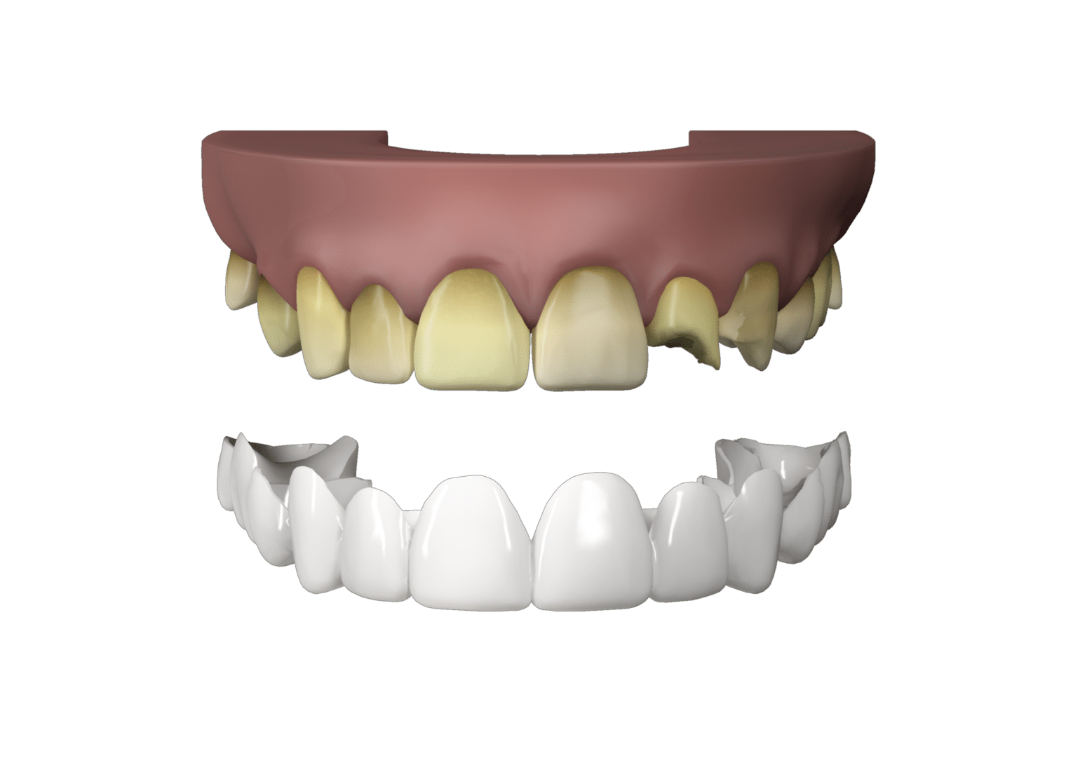 porcelain veneers