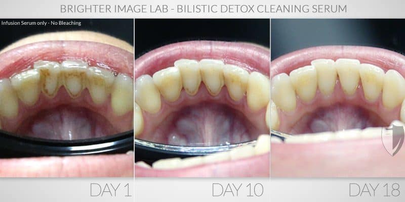 Heather - Actual Brighter Image Lab Client Before and After