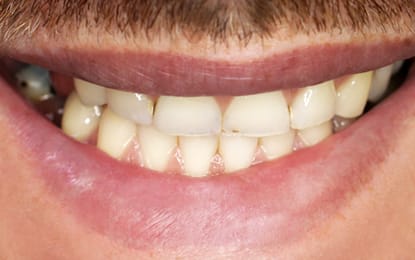 Slider-AJ-Before Slider-AJ-Before