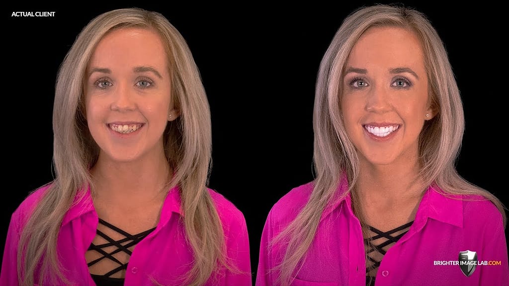 Influencer Smile Makeover