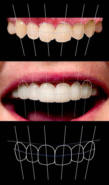 Brighter Image Lab - The Cost of Dental Work Leaves Most with No Real Choice