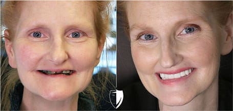 bilveneers-client-angela-p-1.jpg