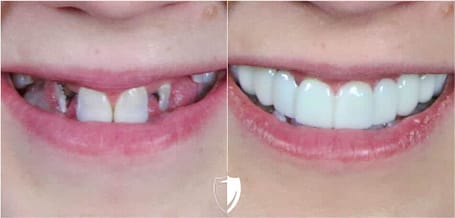 bilveneers-client-stacy-closeup-1.jpg