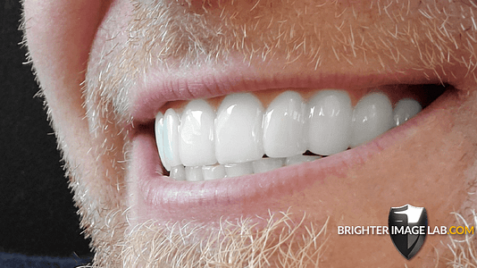 bilveneers-client-ronald-s-1-1.png