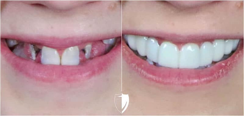 bilveneers-client-stacy-closeup.jpg