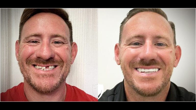 missing-teeth-smile-makeover