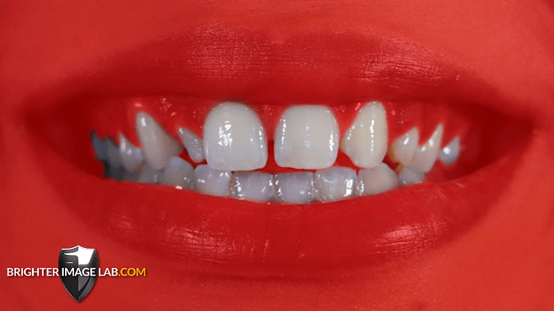 bilveneers-client-before-red-1.png