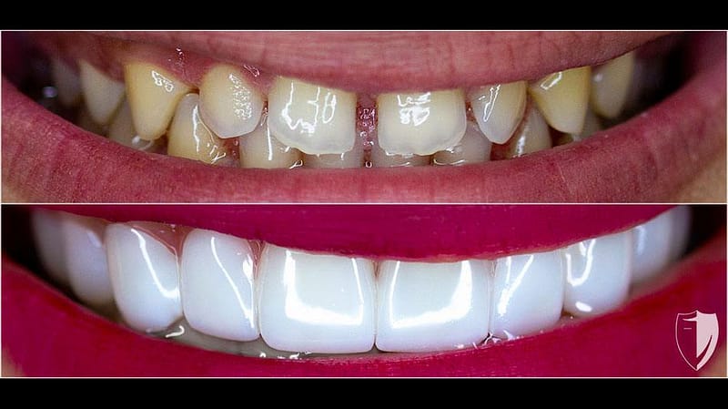 bilveneers-client-cristina-ba-1.jpg