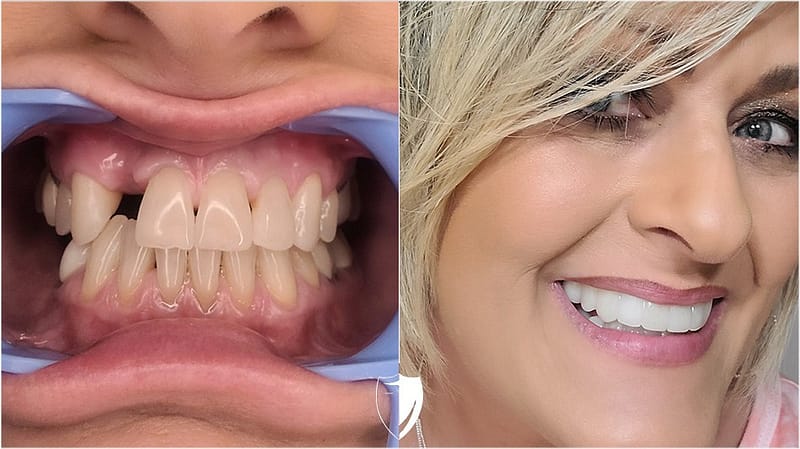 bilveneers-client-dondeana-h-1.jpg