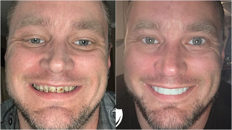 bilveneers-client-jonathan-r.jpg