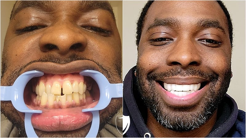 bilveneers-client-kevin-w1.jpg