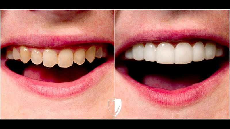 bilveneers-client-kristen-c-1.jpg