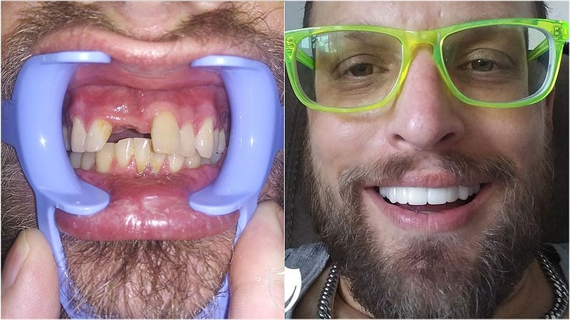 bilveneers-client-matthew-p.jpg