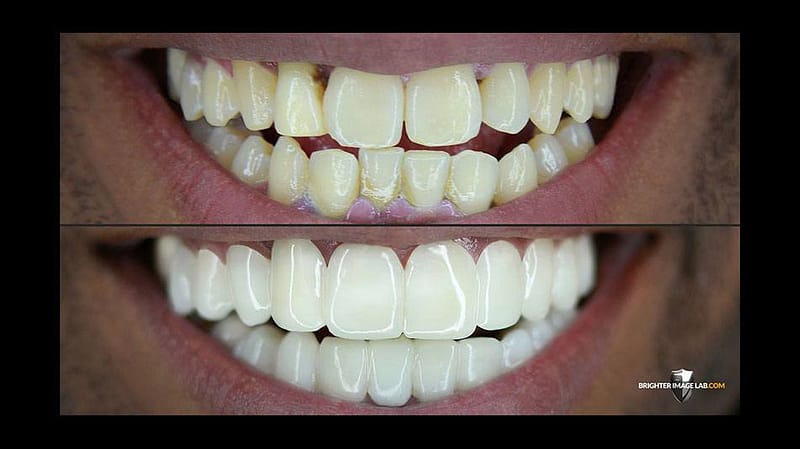 bilveneers-client-reggie-ba.jpg