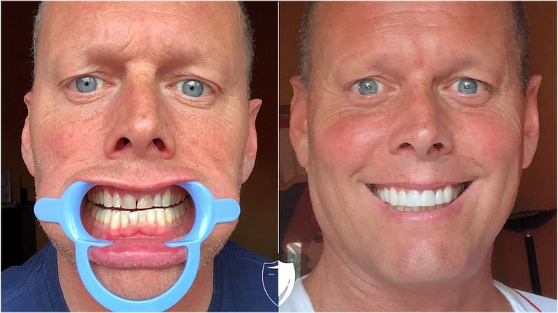 bilveneers-client-robert-g-2.jpg