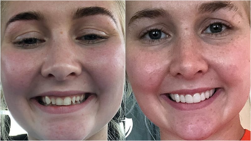 bilveneers-client-sarah-m.jpg