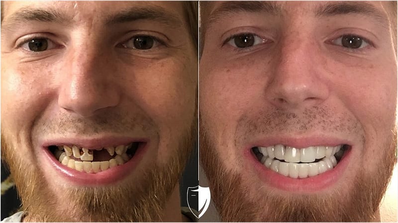 bilveneers-client-scott-k.jpg