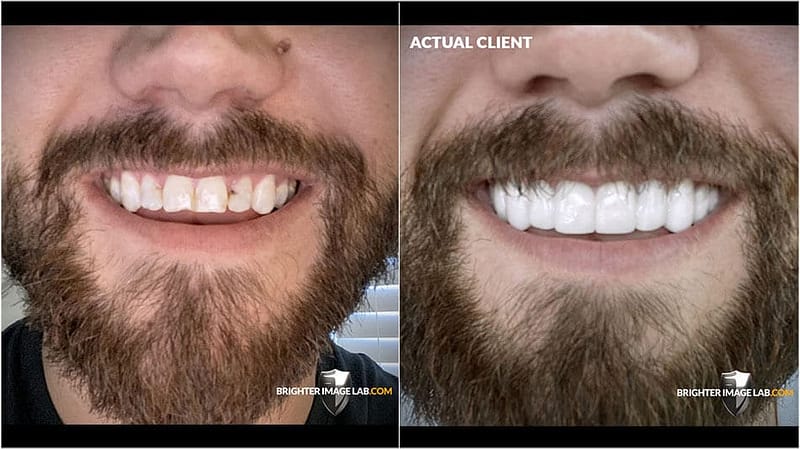 bilveneers-client-tyler-m-close-ba.jpg