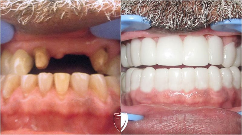 bilveneers-client-willie-t-1.jpg