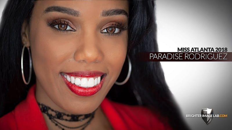 Miss Atlanta Georgia Gets No Dentist Dental Veneers