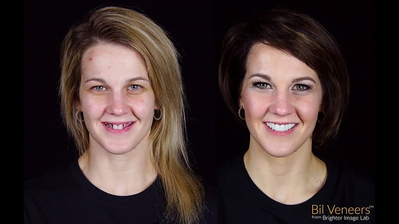 Extreme makeover with Press On Veneers by Brighter Image Lab