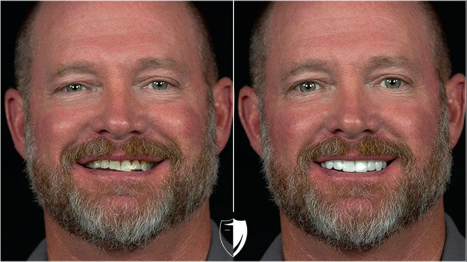 BilVeneers client Marty S