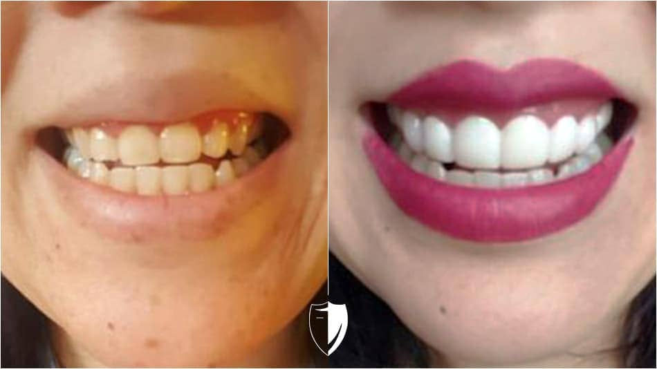 bilveneers-client-nhan-htt-ba