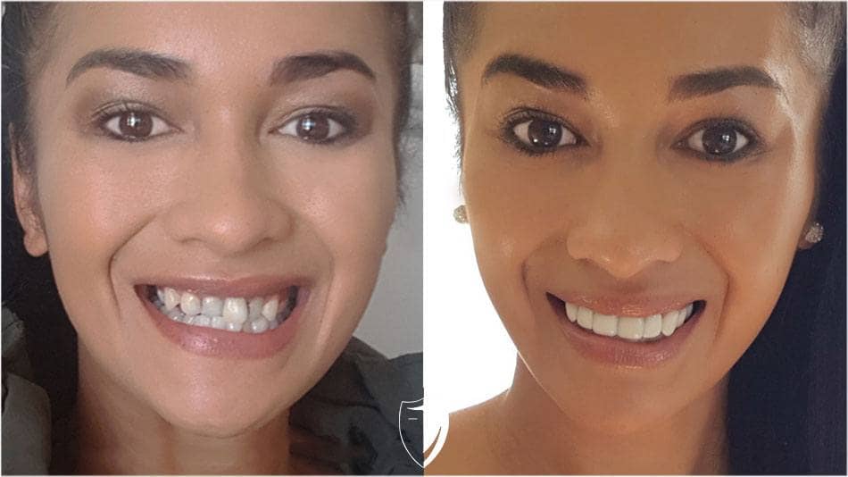 bilveneers-client-nicole-t