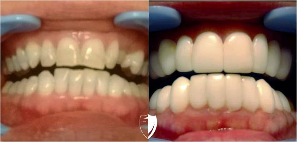 bilveneers-client-billy-kae-c-close-ba