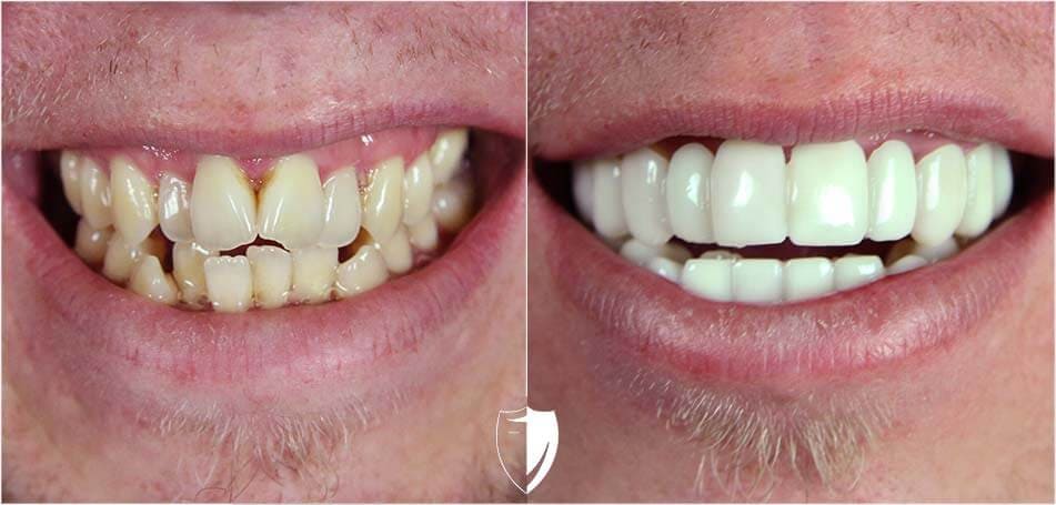 bilveneers-client-dougie-v-ba