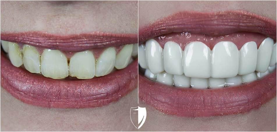 bilveneers-client-jenna-ba