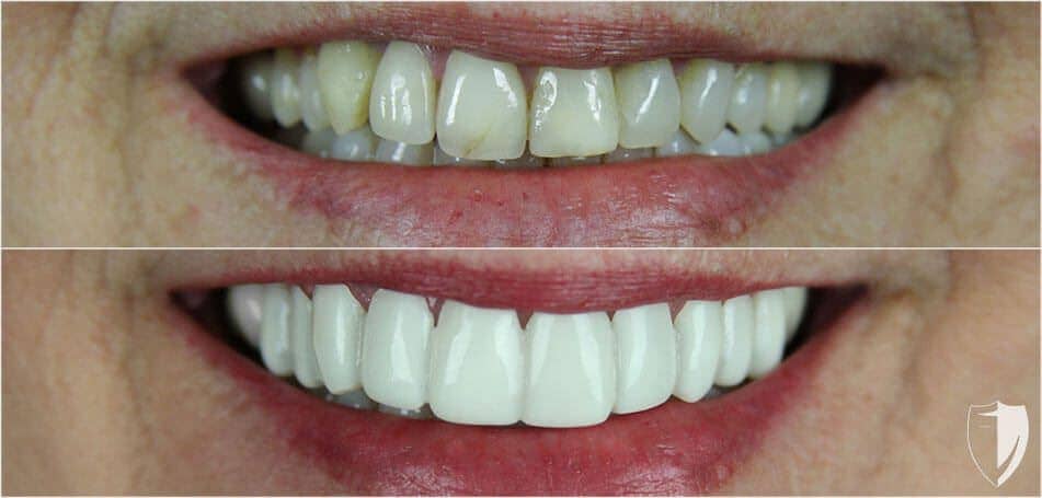 bilveneers-client-jill-d