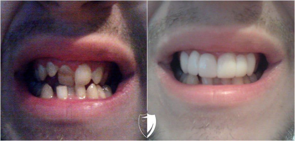 bilveneers-client-johnny-s