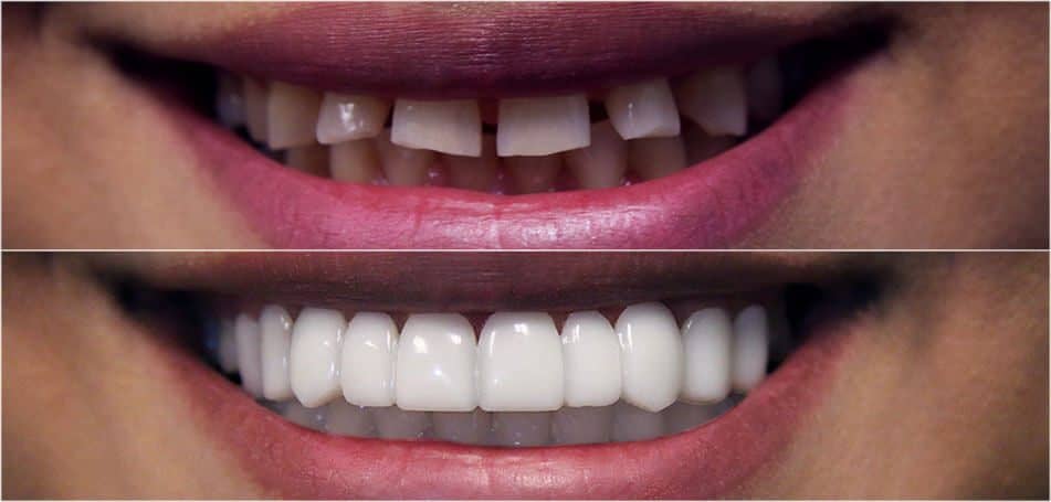 bilveneers-client-maria-ba