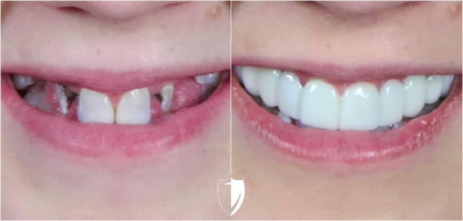 bilveneers-client-stacy-closeup