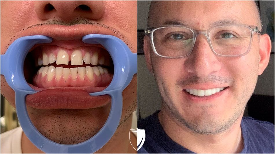 bilveneers-client-alex-g-2