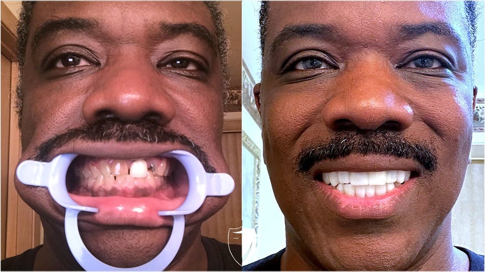 bilveneers-client-andre-s