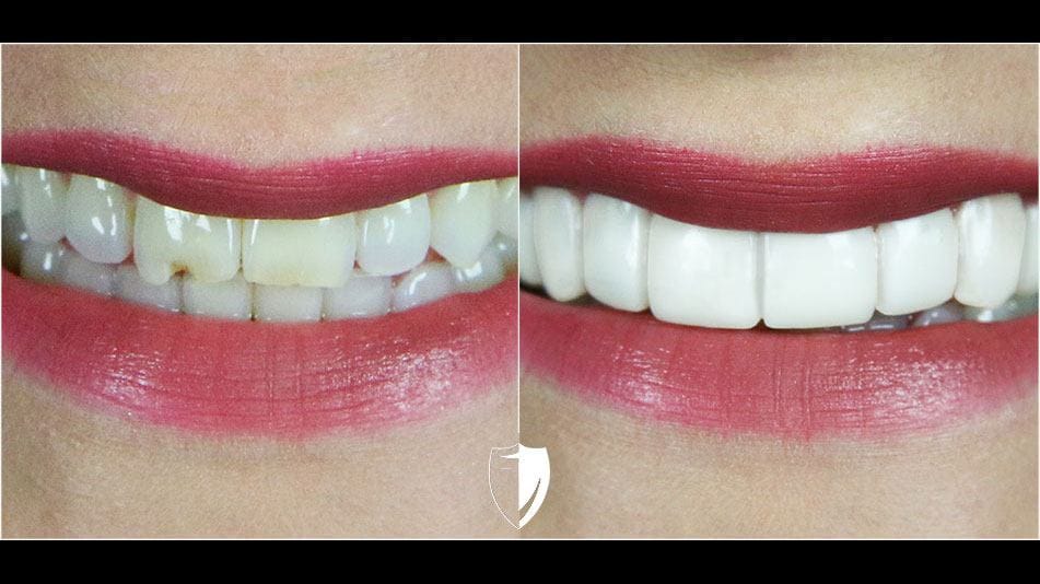 bilveneers-client-bridgette-j-closeup