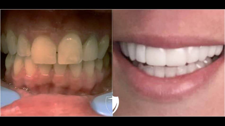 bilveneers-client-brittany-benson-closeup