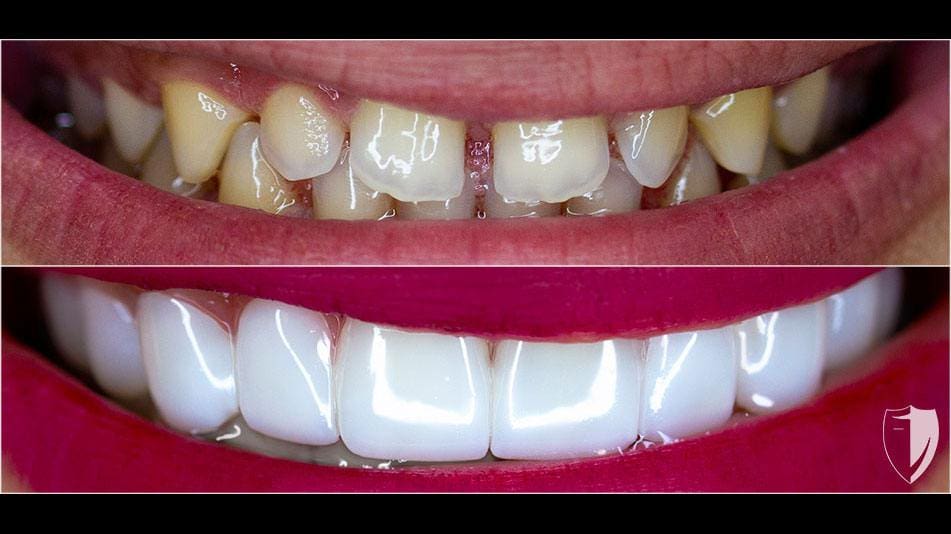 bilveneers-client-cristina-ba