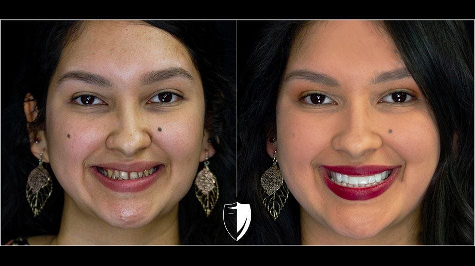 bilveneers-client-cristina