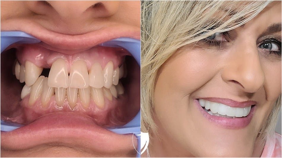 bilveneers-client-dondeana-h