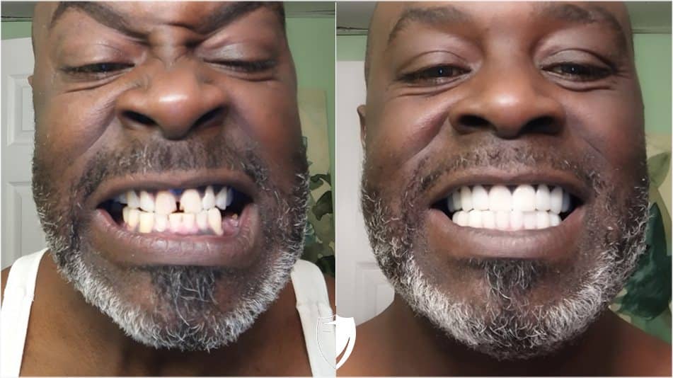 bilveneers-client-gerald-a